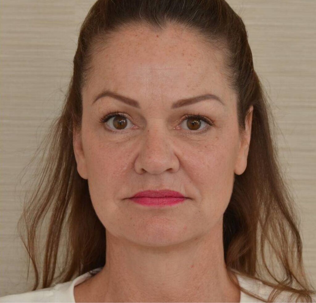 Liquid facelift DokterEs na