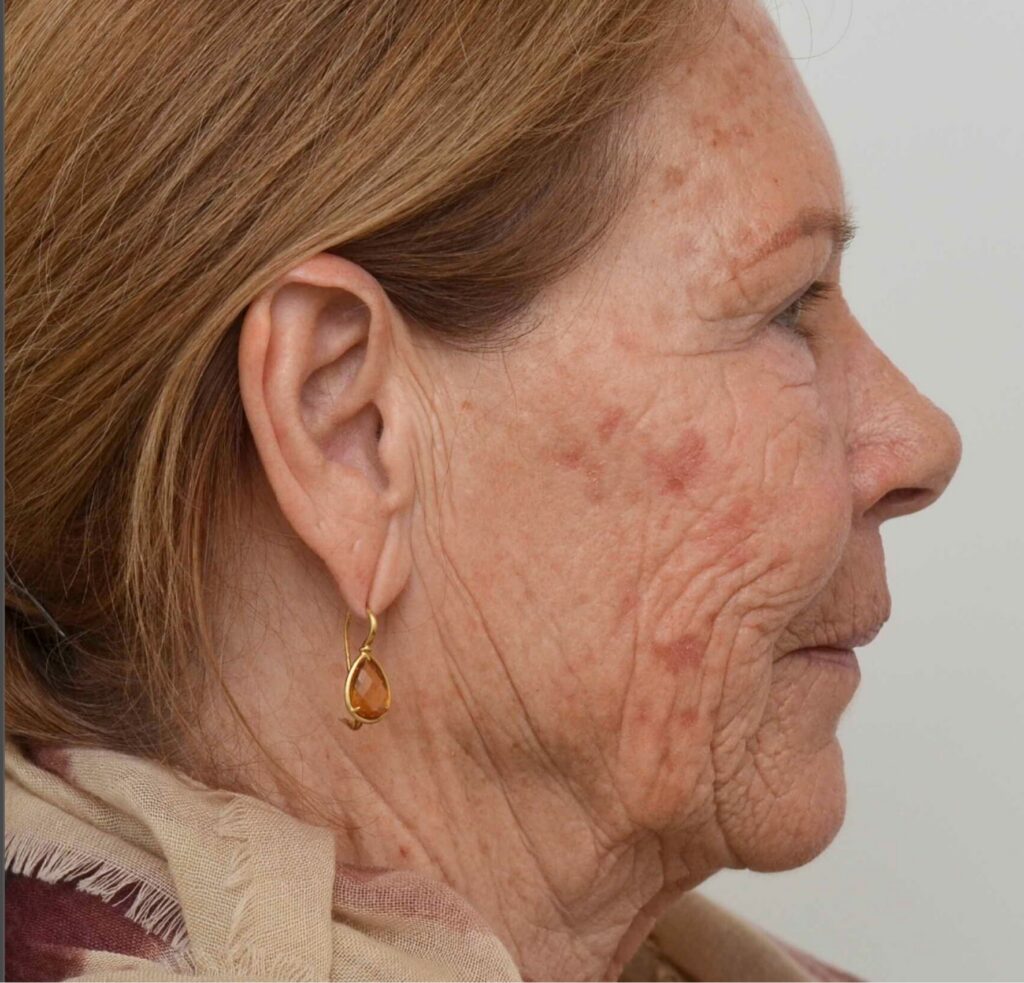 Full-face CO2 DokterEs for