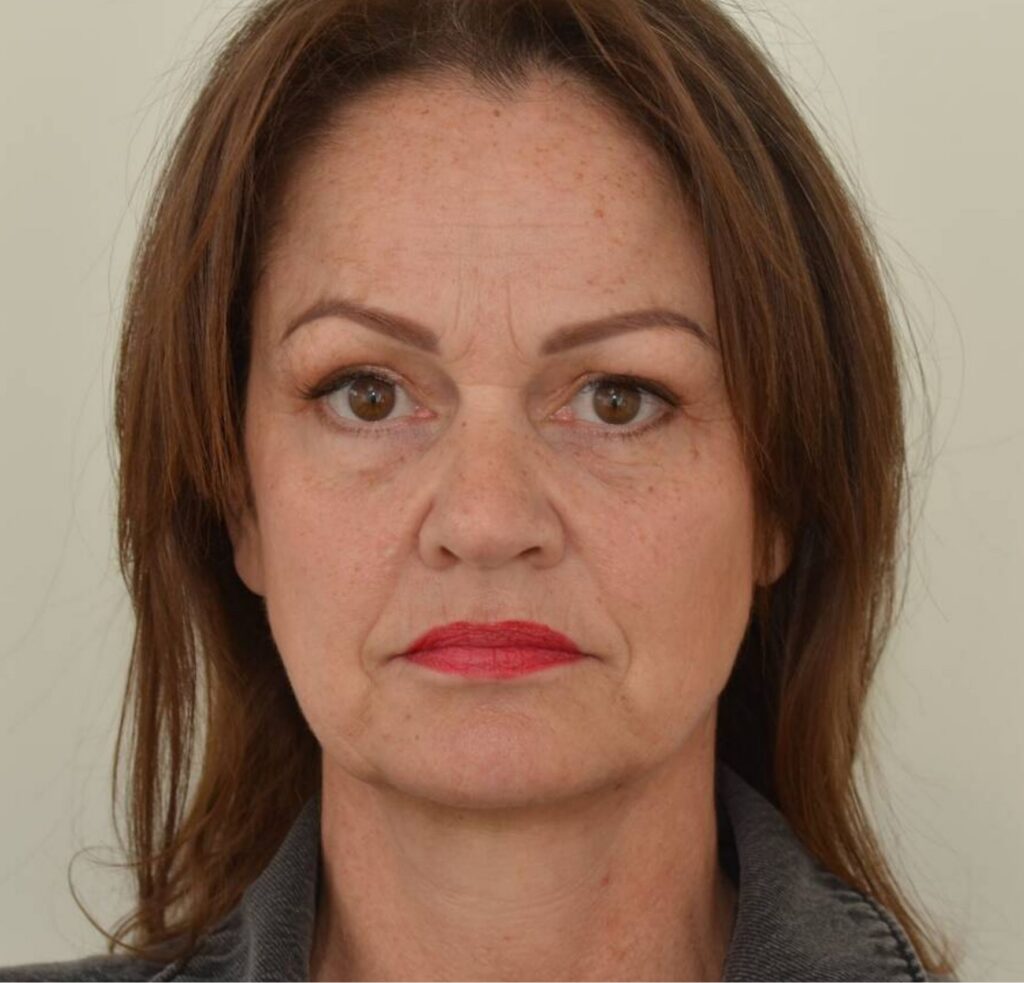 liquid facelift DokterEs voor