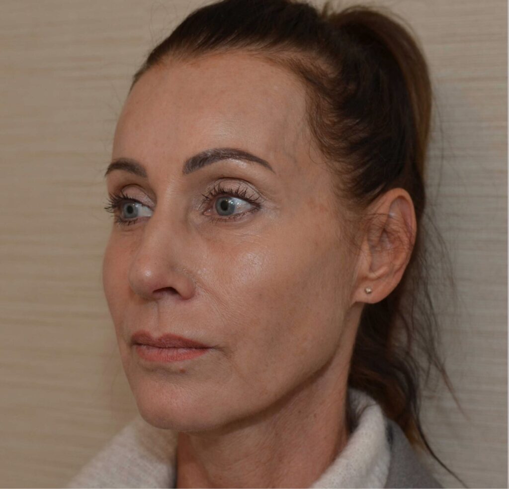 CO2 laser voor en na resultaten DokterEs Eindhoven