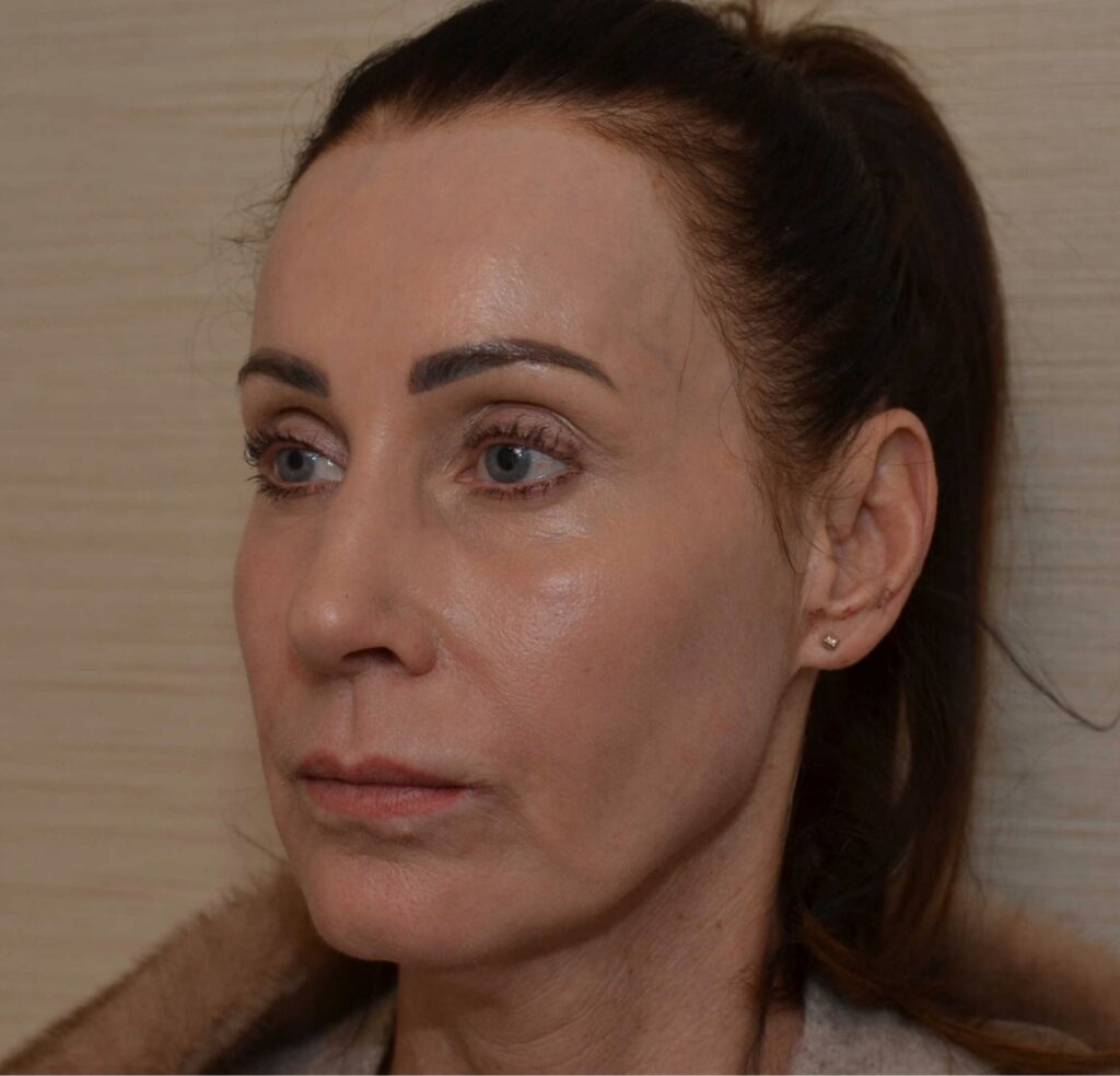 CO2 laser voor resultaat DokterEs Eindhoven