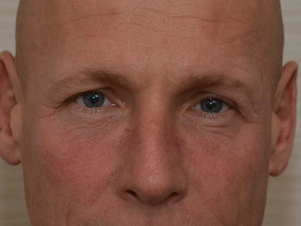 Na resultaat CO2 periorbitaal DokterEs Eindhoven