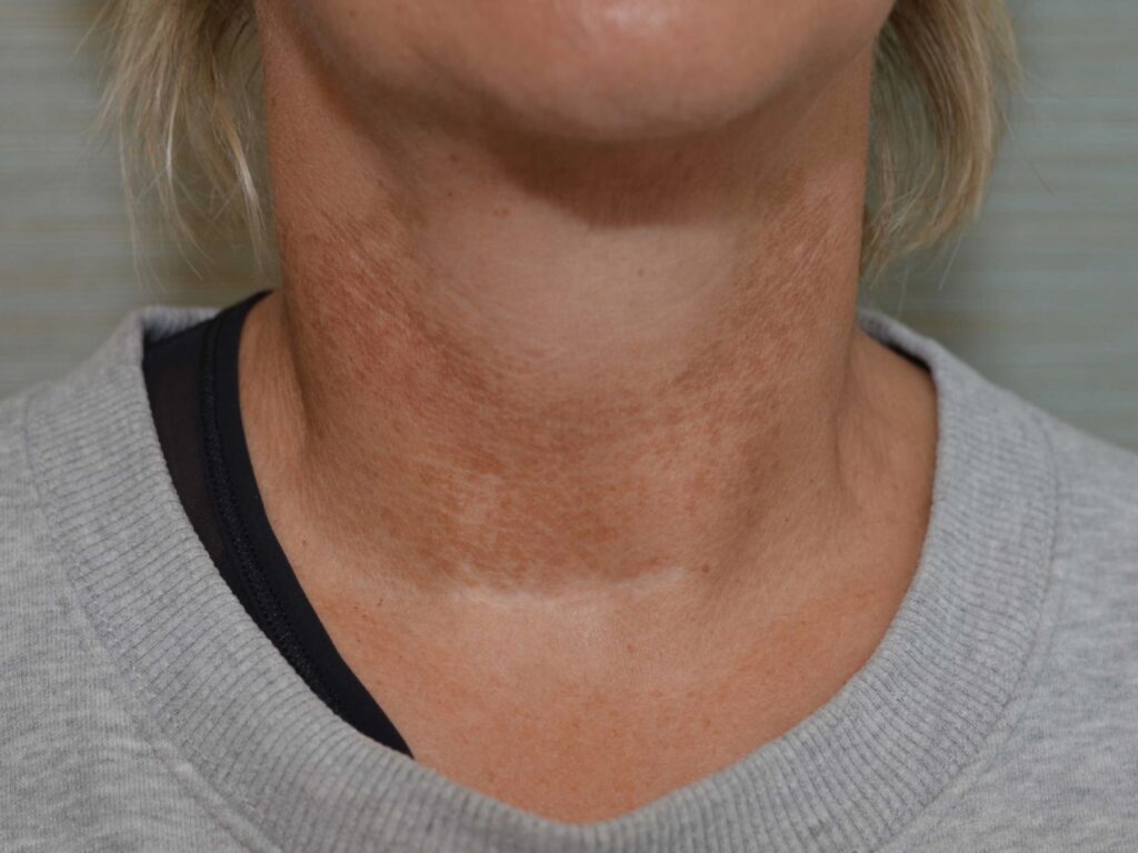 Poikiloderma voor en na VPL dermamelan intimate DokterEs