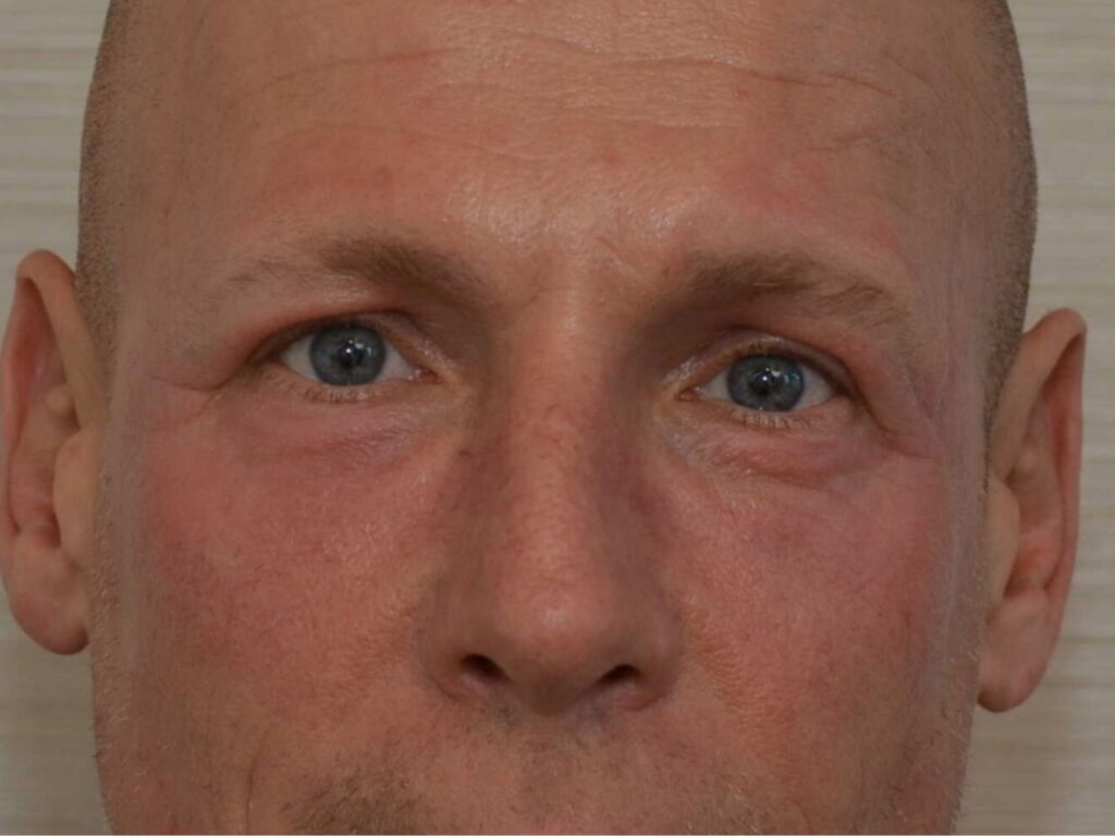 Voor en na resultaat CO2 DokterEs periorbitaal