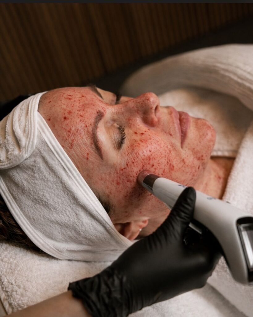 Vampire facial PRP gelaat DokterEs Eindhoven