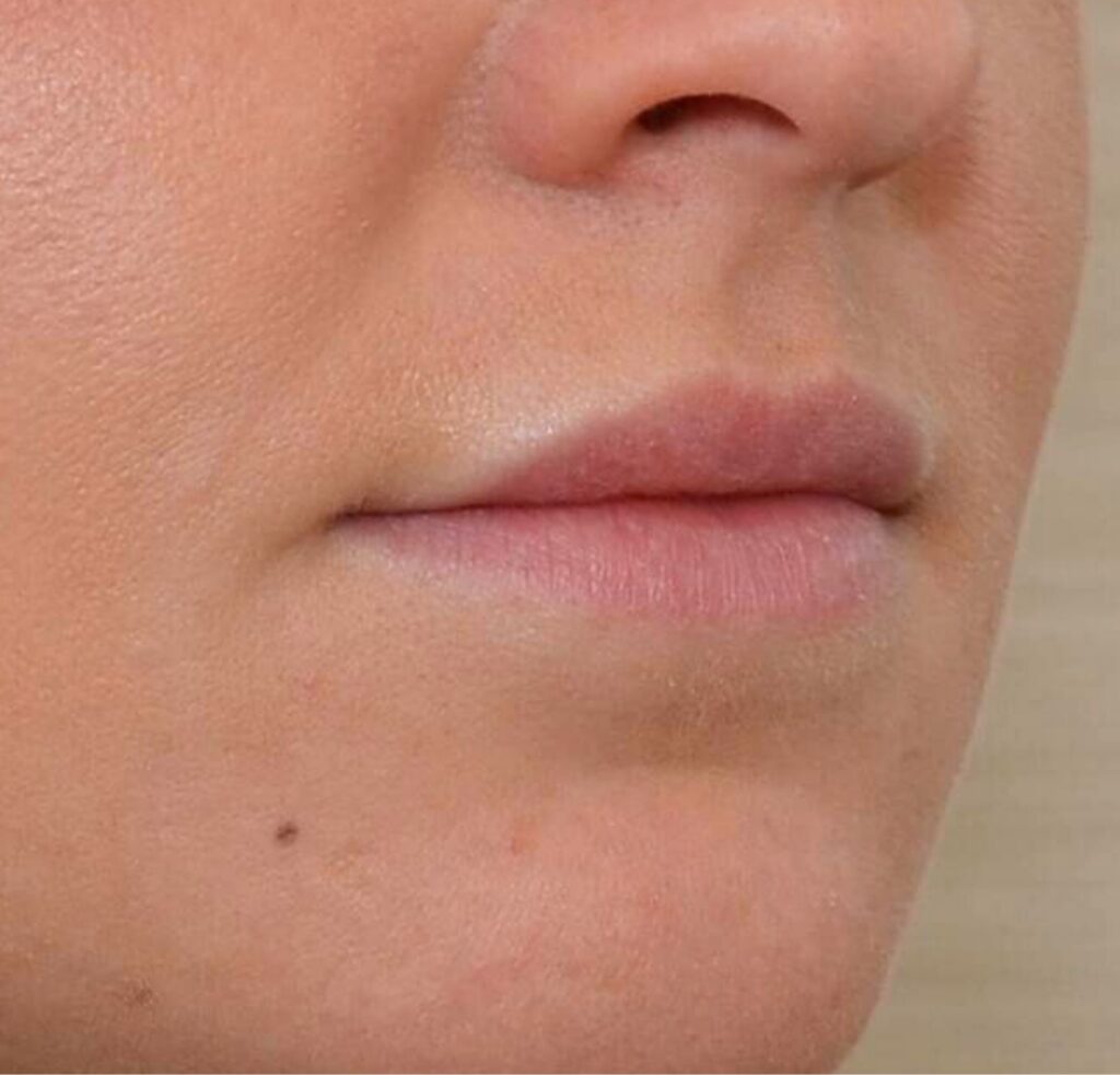 DokterEs Eindhoven Ácido Hialurónico labios antes y después