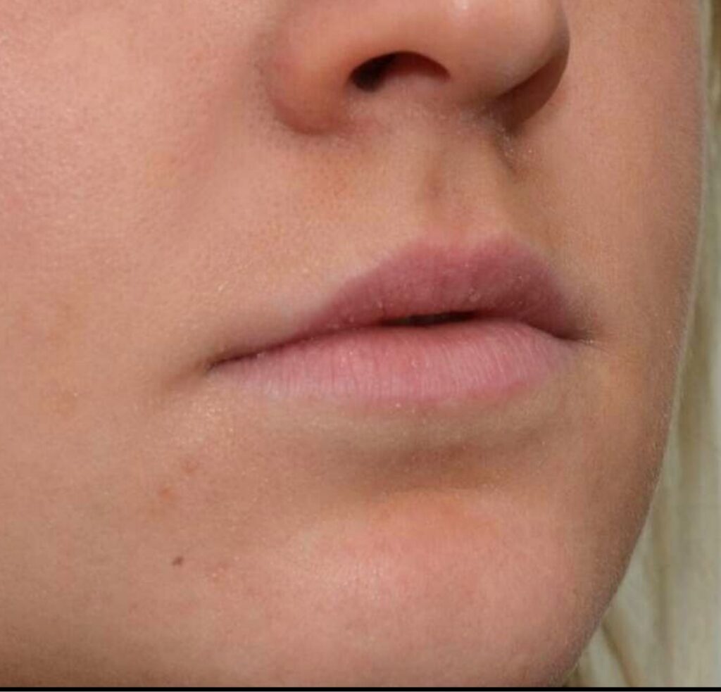 DokterEs Ácido Hialurónico labios antes y después