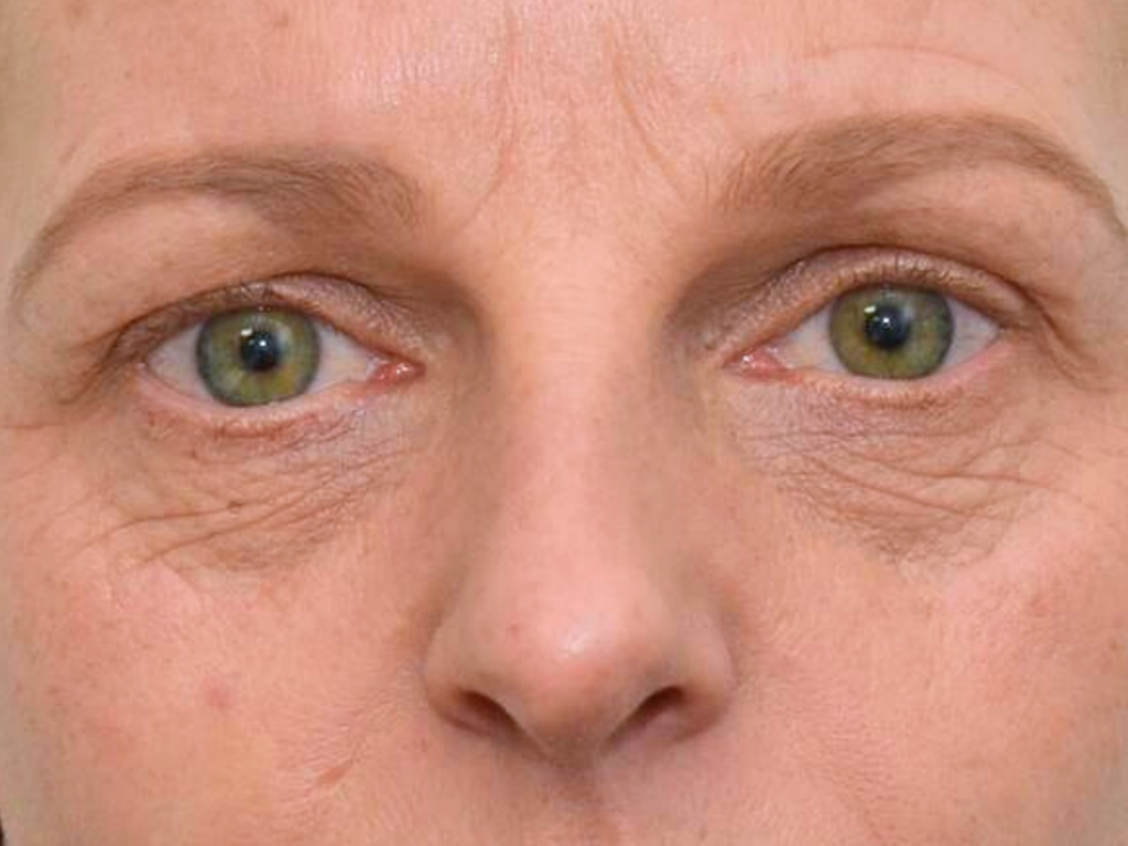 Arrugas bajo los ojos con láser de CO2 antes y después