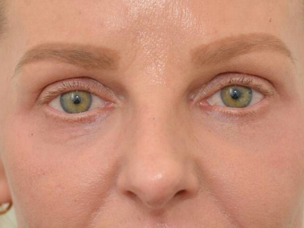 Arrugas bajo los ojos con láser de CO2 antes y después