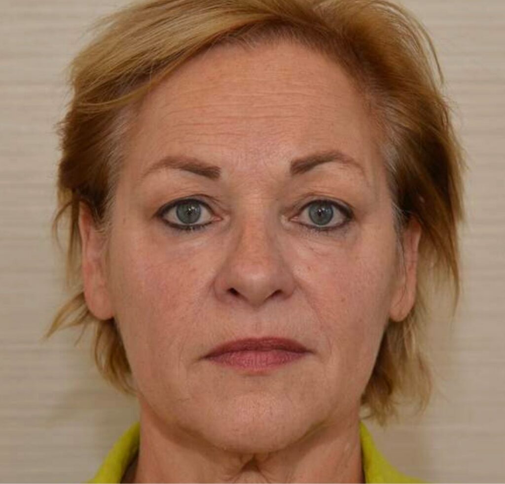 Filler for tear troughs and nasolabial folds at DokterEs